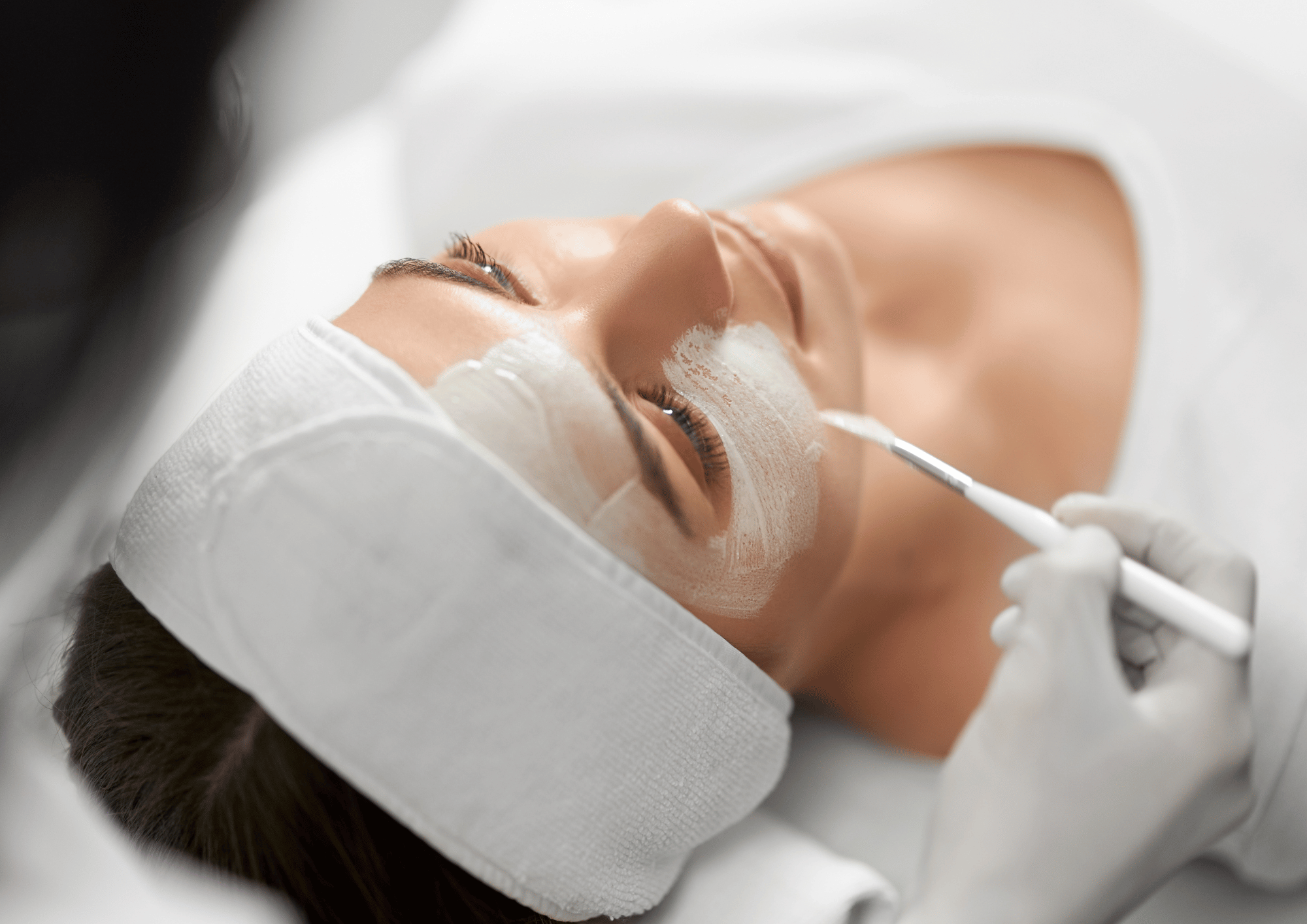 Chemical peels: A revolution in skin care